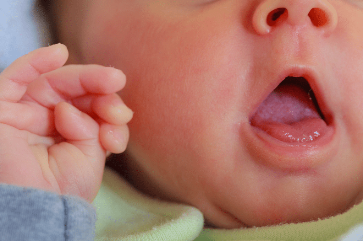 Lip Tie em bebês o que os pais precisam saber Filhos e Filhas